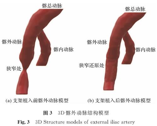 图3 3D髂外动脉结构模型<br/>Fig.3 3D Structure models of external iliac artery