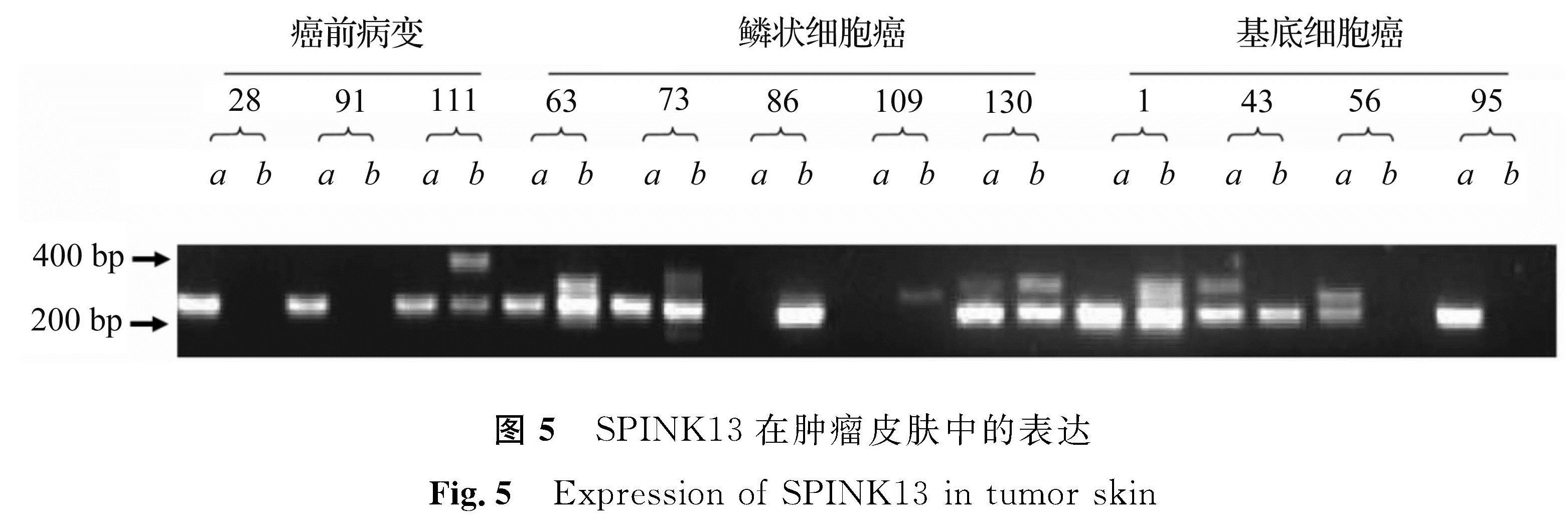 图5 SPINK13在肿瘤皮肤中的表达<br/>Fig.5 Expression of SPINK13 in tumor skin